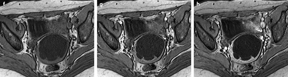 Benign Diseases of the Cervix | Radiology Key