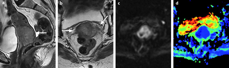 Cancer Lump On Cervix