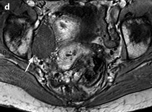 Anatomy And Radioanatomy Of The Pelvis And The Perineum And Anatomical