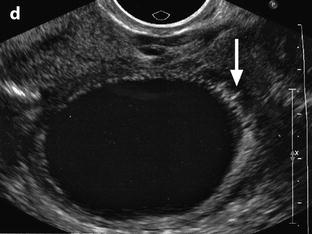 pelvic inflammatory disease ultrasound