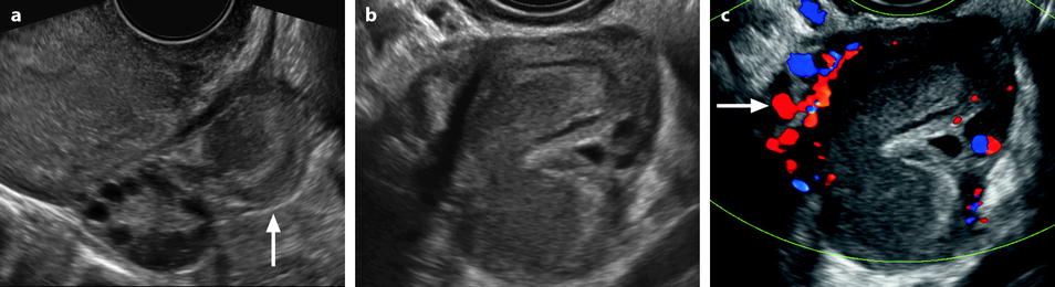Pelvic Inflammatory Disease Radiology Reference Article Radiopaediaorg Pelvic Inflammatory Disease Radiology Reference Article Radiopaediaorg