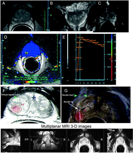 Multiparametric Magnetic Resonance Imaging Approaches In Focal Prostate Cancer Therapy