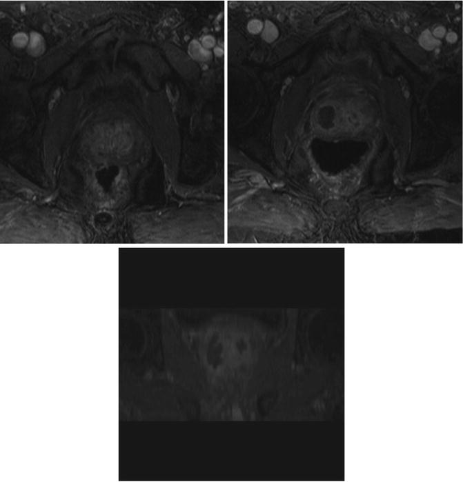 Photodynamic Therapy For Early Prostate Cancer Radiology Key