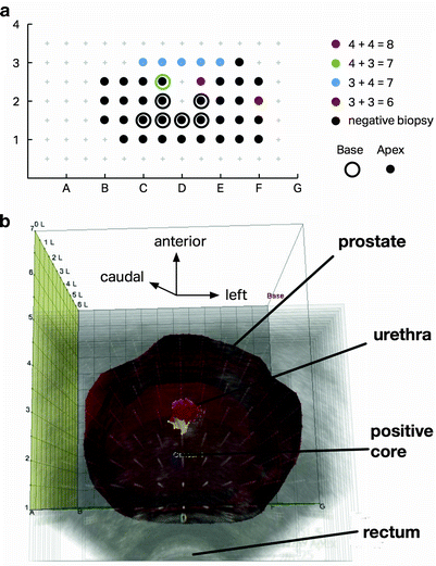 3d Image Guided Mapping Biopsy For Defining Spatial Distribution Of