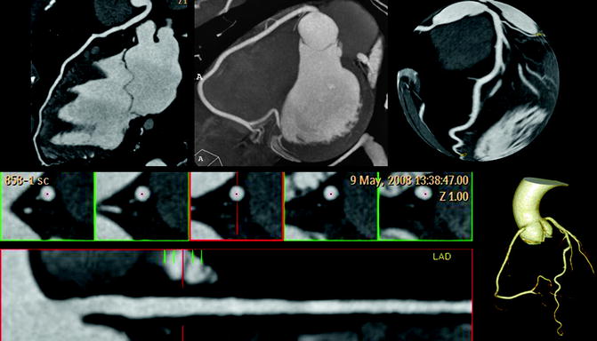 Congestive Heart Failure | Radiology Key