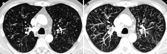 Airway Disease | Radiology Key