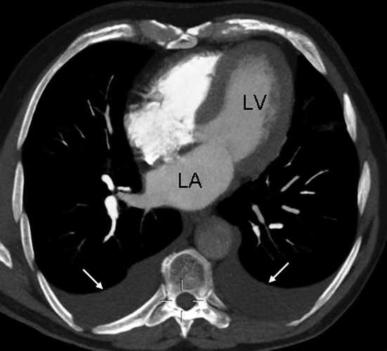 Thromboembolic Disease and Pulmonary Hypertension | Radiology Key