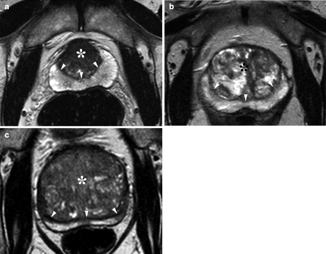 Benign Prostate Hyperplasia And Prostatic Tumor Radiology Key 2451