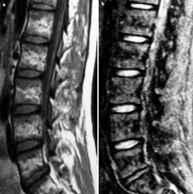 Age-Related Pathological Changes of the Bone Marrow and Immune System ...