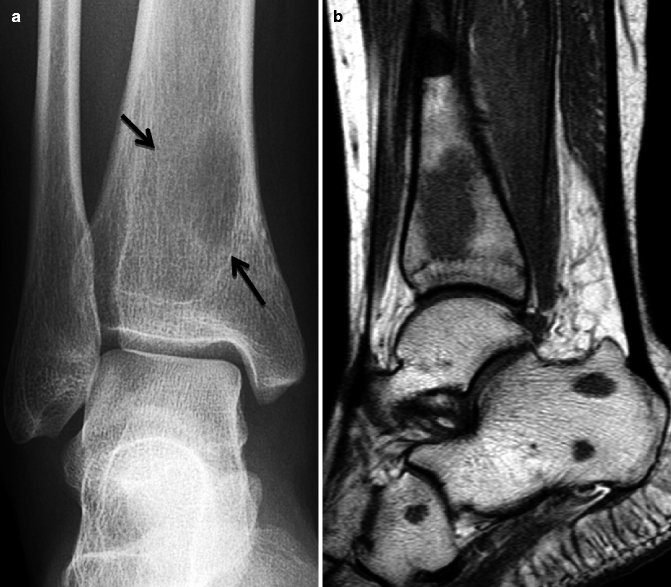 Age-Related Pathological Changes of the Bone Marrow and Immune System