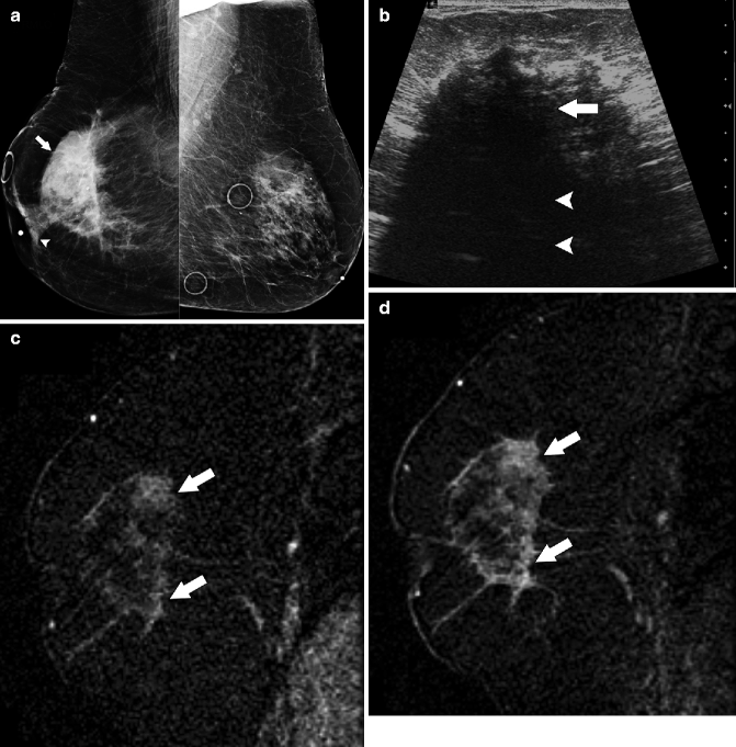 malignant-breast-tumors-radiology-key