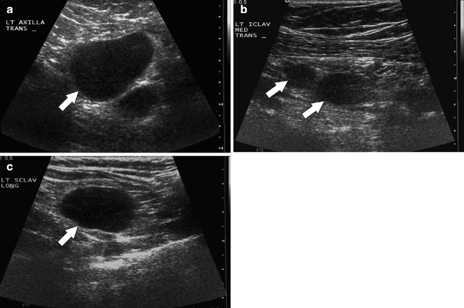 Malignant Breast Tumors | Radiology Key