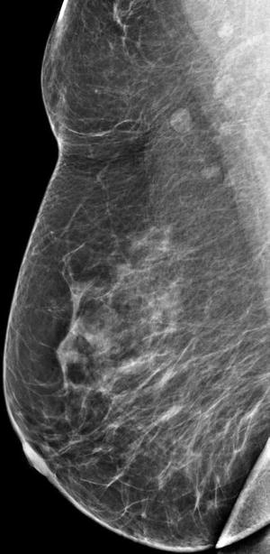 The Negative Fallout from Skin Tears in Mammography