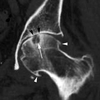 Imaging Of Osteoarthritis | Radiology Key