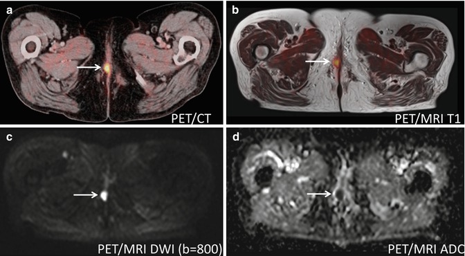 Hybrid PET Imaging: PET with MRI and CT