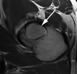 Extra-articular Conditions | Radiology Key