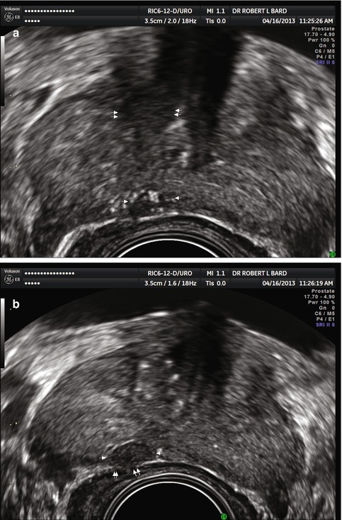 Diagnostic Ultrasound Imaging Of The Prostate Radiology Key