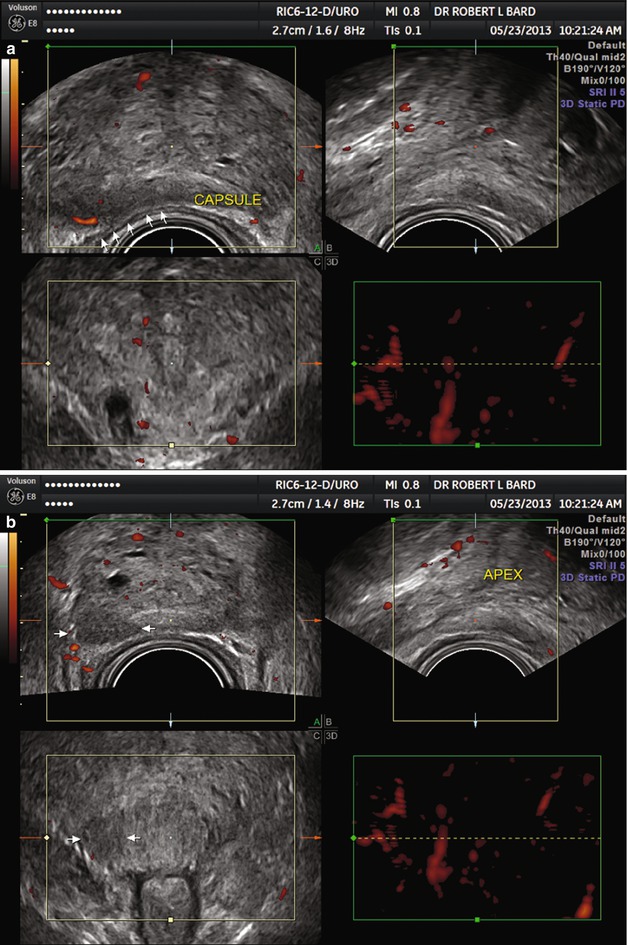 Diagnostic Ultrasound Imaging Of The Prostate Radiology Key 7791