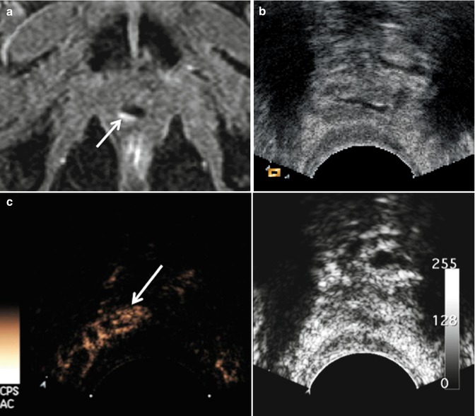 Contrast Enhanced Ultrasound In Prostate Cancer Radiology Key