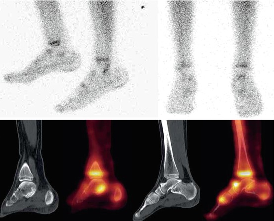 SPECT/CT in Orthopedics | Radiology Key