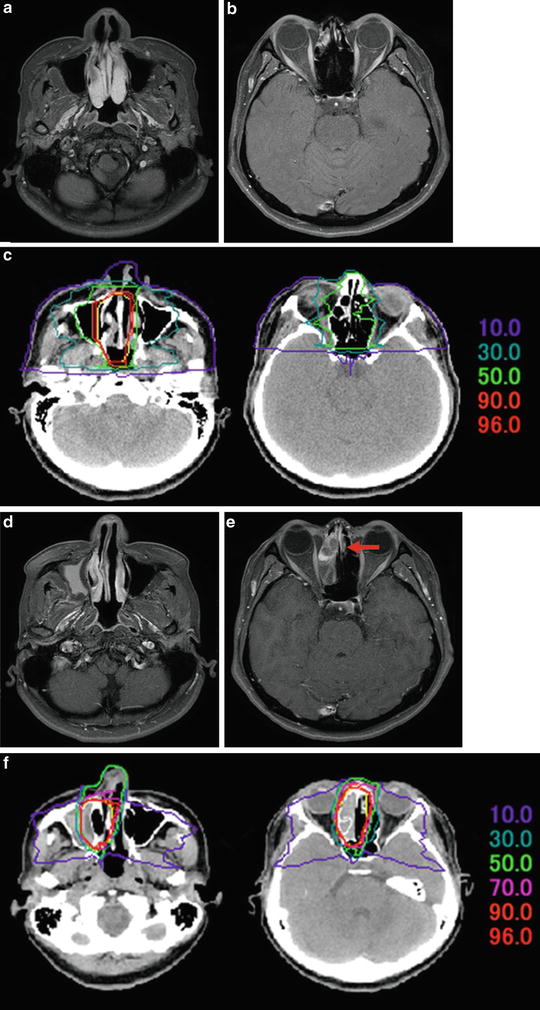 Malignant Melanoma of the Head and Neck | Radiology Key