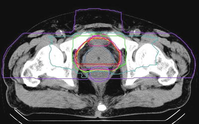 Prostate Cancer | Radiology Key