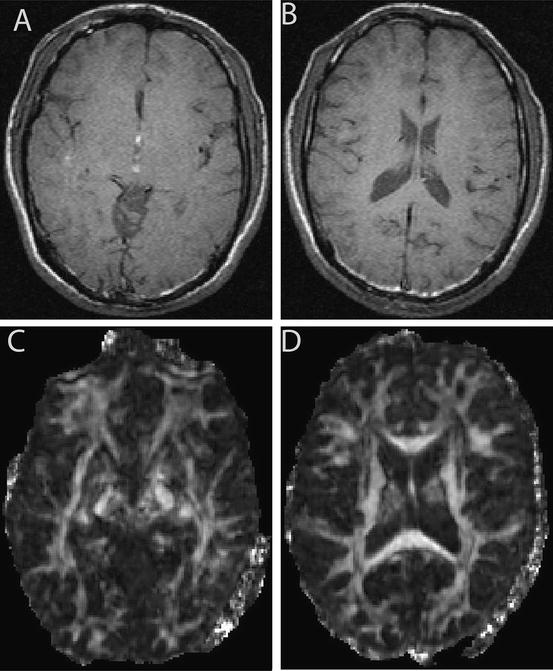 Diffusion-Weighted Imaging Analysis | Radiology Key