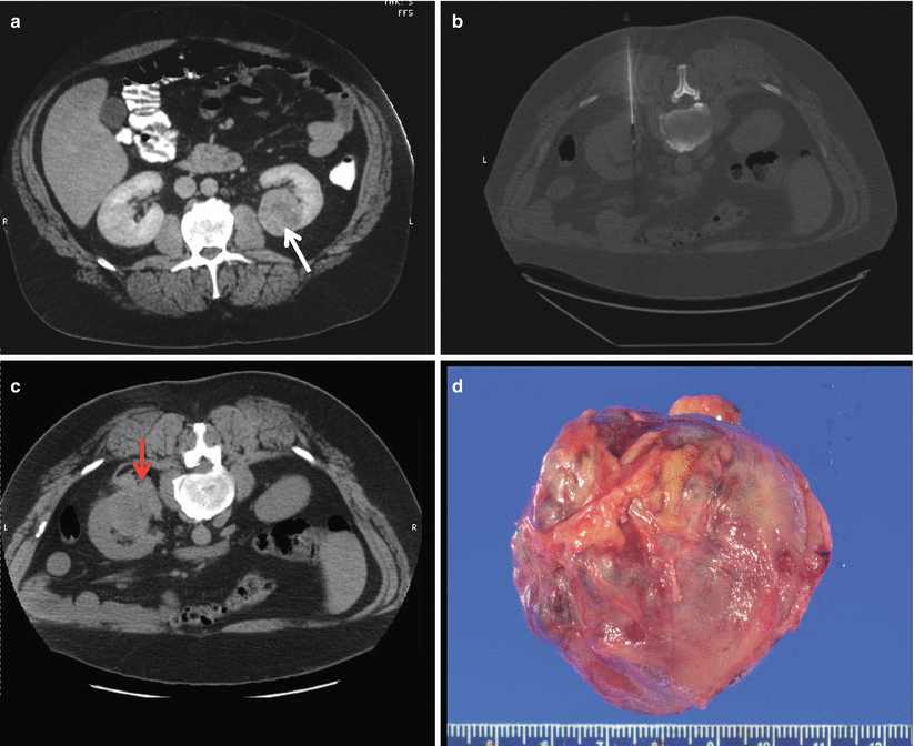 Renal Mass Biopsy Radiology Key