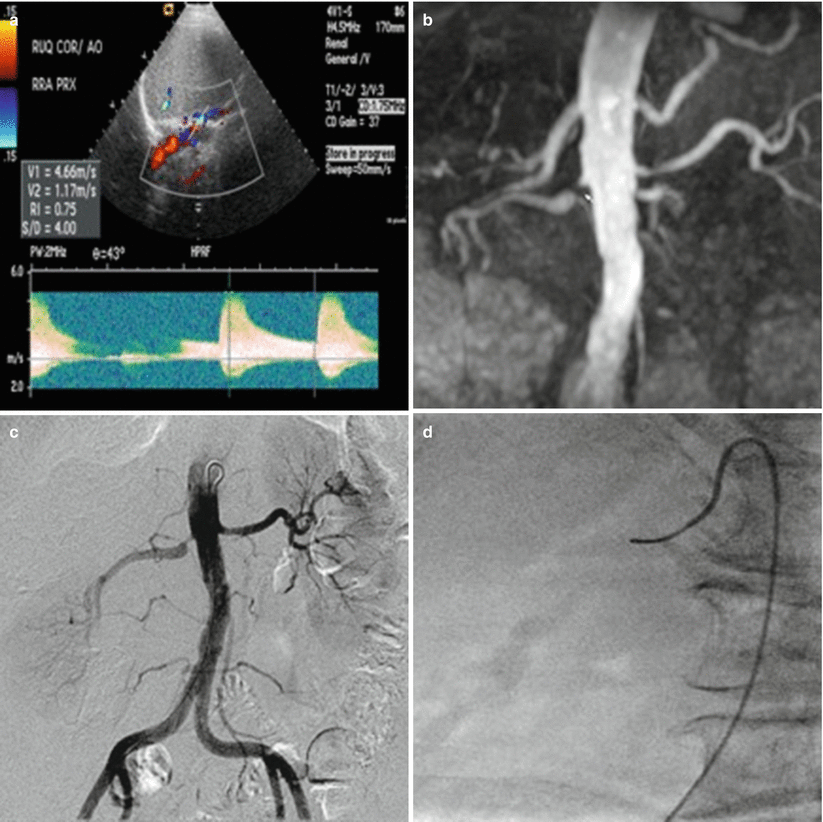 Renal Artery Stenosis Radiology