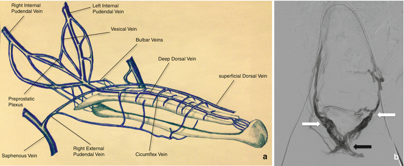 Endovascular Management of Priapism and Erectile Dysfunction