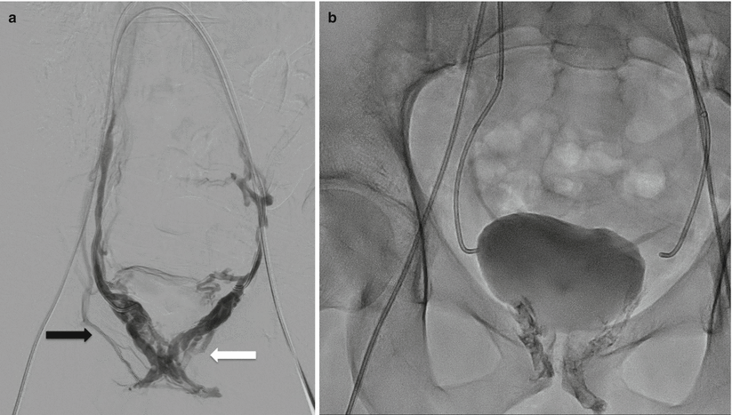 Endovascular Management of Priapism and Erectile Dysfunction