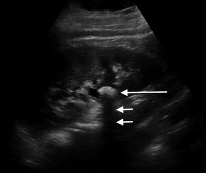 A) A B-mode ultrasound image of a bladder in a transverse section