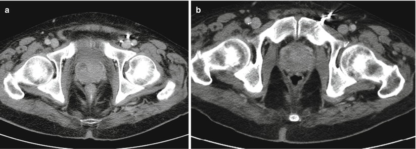 prostatitis on ct scan)