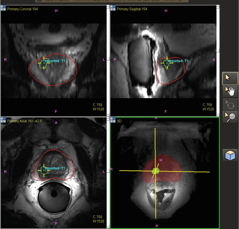 Fusion Guided Prostate Biopsy Radiology Key