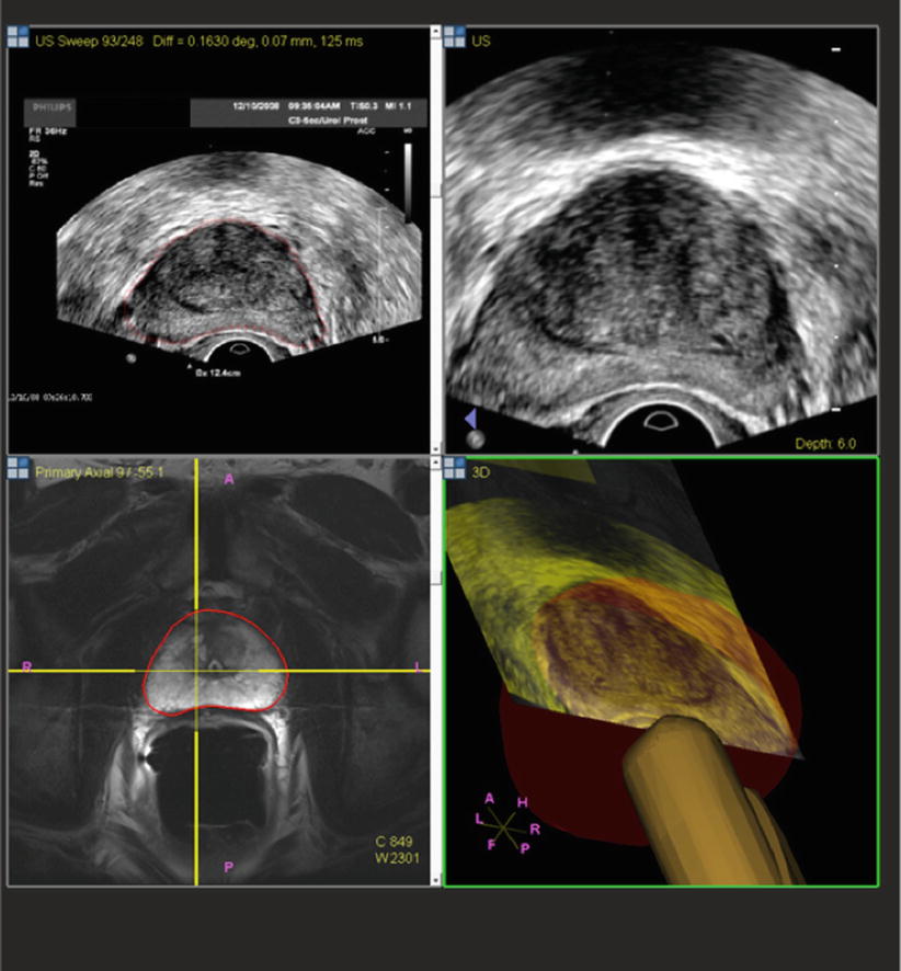 Fusion Guided Prostate Biopsy Radiology Key 8628