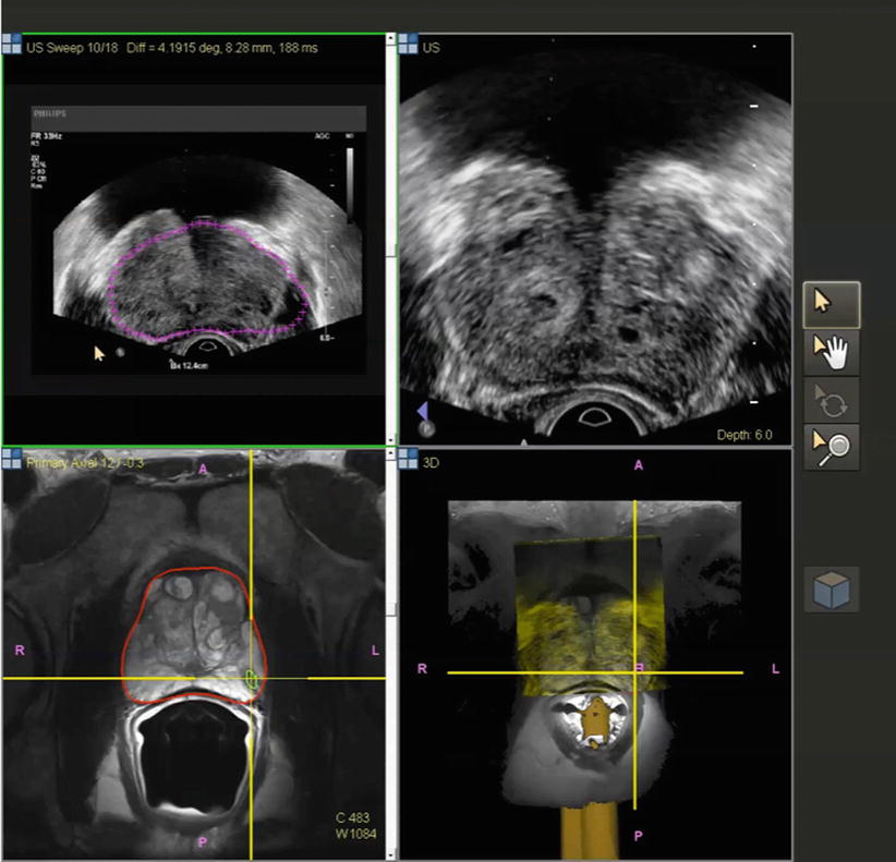 Prostate Biopsy Positioning