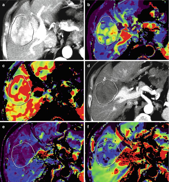 hepatocellular-carcinoma-radiology-key