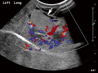 Intra-abdominal and Retroperitoneal Masses | Radiology Key