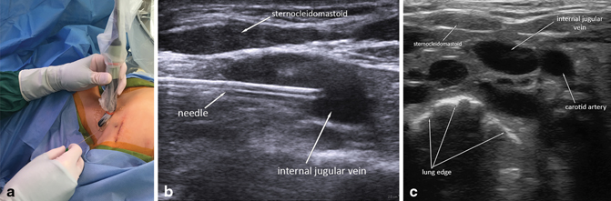Ultrasound Guided Femoral Access