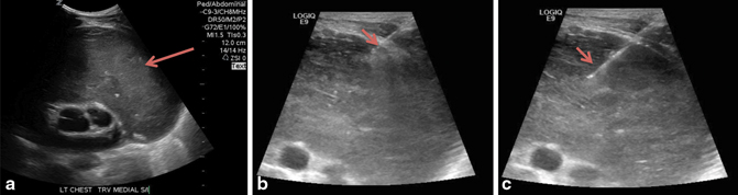 Core Biopsy of Masses and Solid Organs | Radiology Key