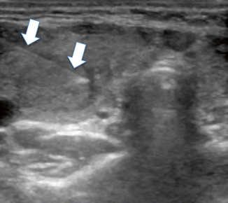 Fine Needle Aspiration (FNA) of the Thyroid Gland | Radiology Key