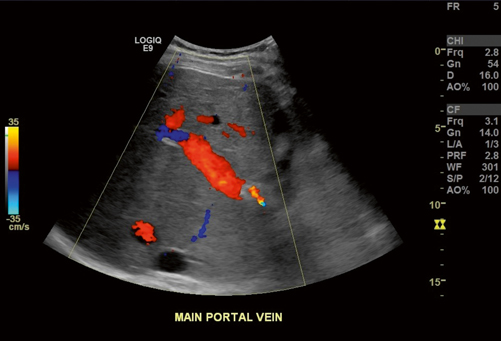 Liver Doppler Ultrasound