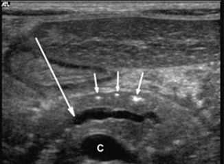 Phlegmonous Pancreatitis Ultrasound