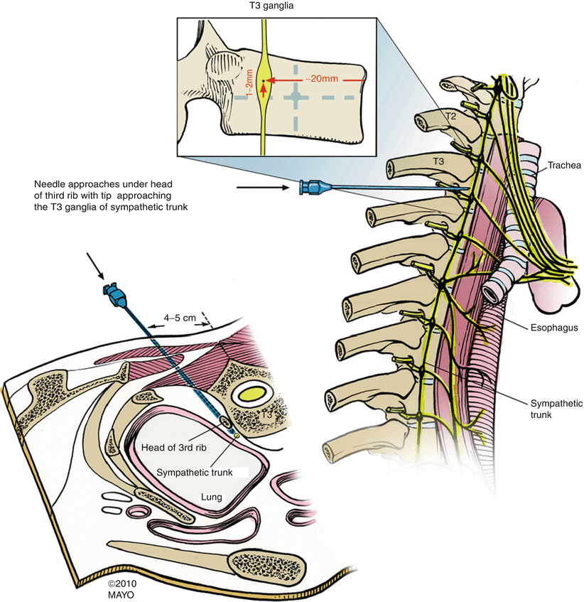 Stellate Ganglion Sympathetic Nerve Block Injection P 8980