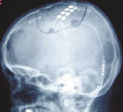 Motor Cortex Stimulation | Radiology Key