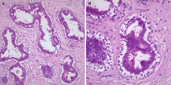 Columnar Cell Lesions | Radiology Key