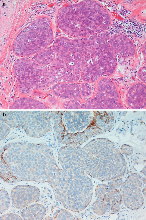 Pathology Of Benign Breast Lesions Radiology Key