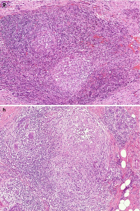 Duct ectasia with inflammatory infiltrates in a 38-year-old woman.