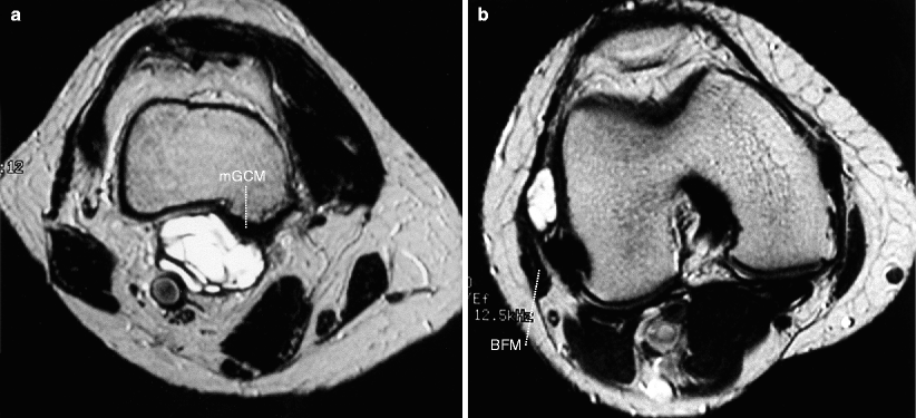 Cystic And Cyst Like Lesions Of The Knee Radiology Key 4005