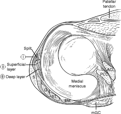 Medial Collateral Ligament
